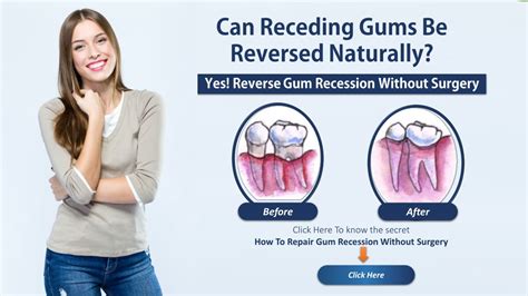 PPT - Reverse Receding Gums Naturally PowerPoint Presentation, free download - ID:8189512