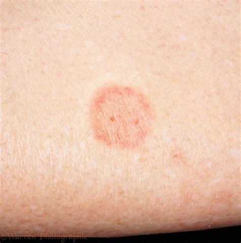 How Contagious Is Ringworm From Cats To Humans at Carolann Ness blog