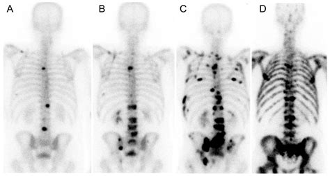 Dosimetric Analysis of the Short-Ranged Particle Emitter 161Tb for ...