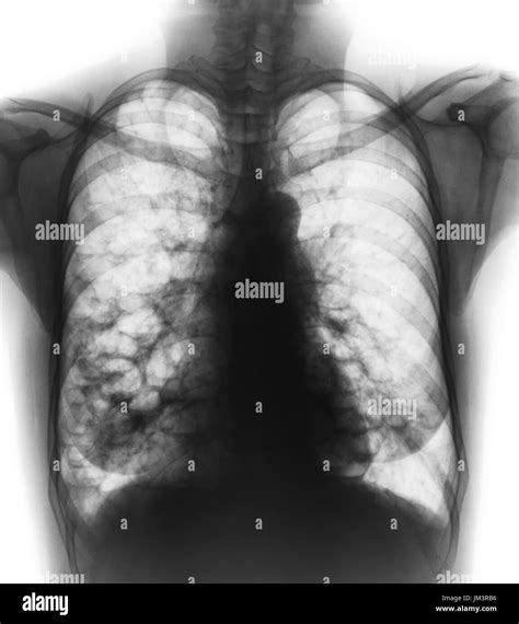 Bronchiectasis . X-ray chest show multiple lung bleb and cyst due to chronic infection . Front ...