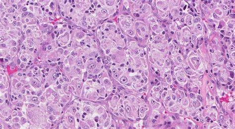 Your pathology report for alveolar soft part sarcoma | MyPathologyReport