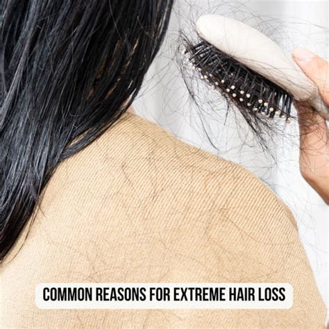 Hair Falling Out Like Crazy? Here’s What You Can Do | Clinikally