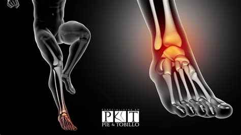 ¿Qué es una fractura de tobillo? | Especialistas en Pie y Tobillo