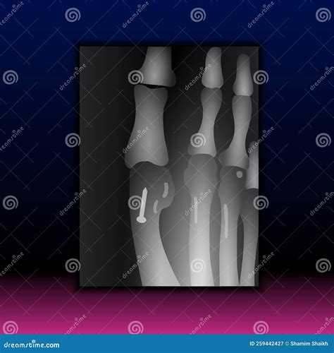 X-ray of Foot Claw - Human Anatomy - Healthcare - Science Stock Illustration - Illustration of ...