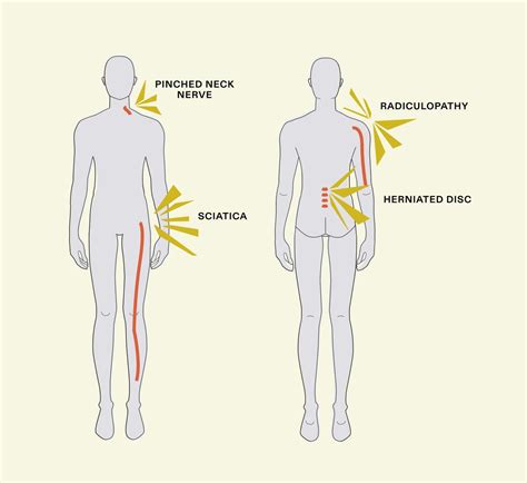 What is a Pinched Nerve? [Common Causes & Treatments]