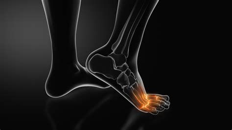 Managing Metatarsalgia in LA - Eazy foot