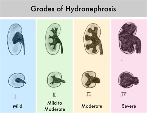 Hydronephrosis — TPA