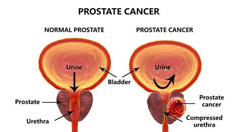 Prostate Cancer and Sexual Functioning: What You Need to Know
