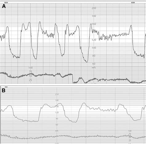 Pathophysiological interpretation of fetal heart rate tracings in clinical practice - American ...