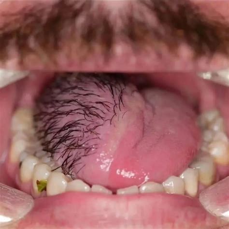 DentalRadar | 🇺🇸Filiform wart on the lip Filiform warts look different ...