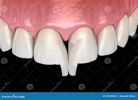 Diastema Treatment: Micro Veneer Installation Procedure Over Central Incisor. Medically Accurate ...