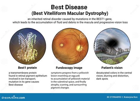 Best Vitelliform Macular Dystrophy, Atrophic Stage, Retinal Atrophy, Illustration, Fluorescein ...