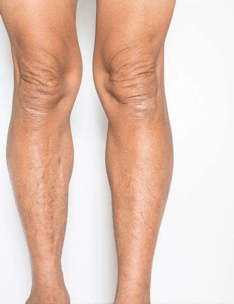 What is muscle atrophy | Zanskar Health Blog
