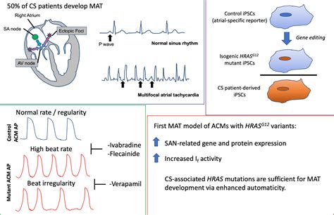 What Is Multifocal Atrial Tachycardia