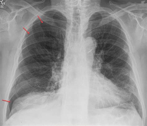 How To Read A Pneumothorax X Ray at Willard Nolen blog