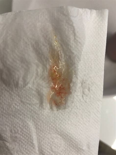 Flujo con hilo de sangre a 7 dpo | BabyCenter