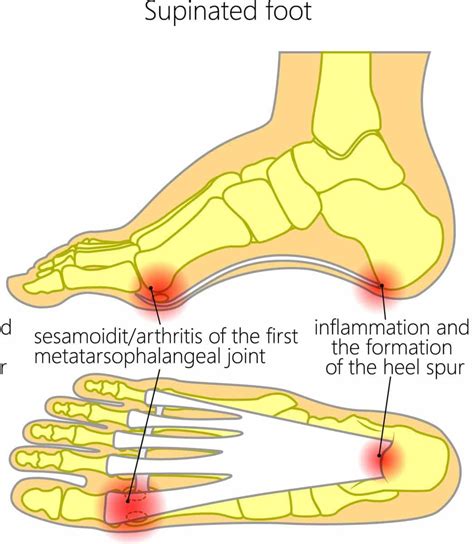 Pain on the Inside of the Foot: #1 Causes & Best Treatments