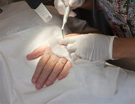 Cauterizing 的图像结果