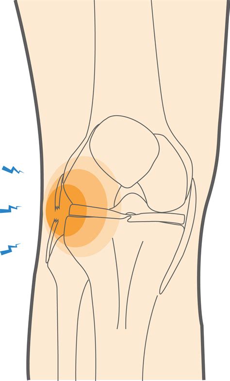 What Are Lateral Collateral Ligament (LCL) Tears & How Can You Heal?