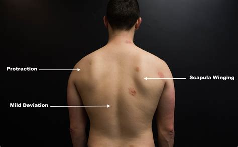 Winged Scapula and Shoulder Pain [Case Study] — ONI | Wellington ...
