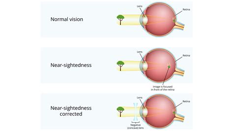 Understanding Long and Short Sightedness Differences