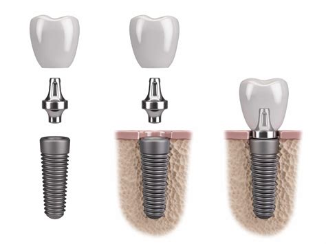 Livonia Dentist Looks At The Different Parts Of A Dental Implant | Dr. James Stewart | Livonia, MI