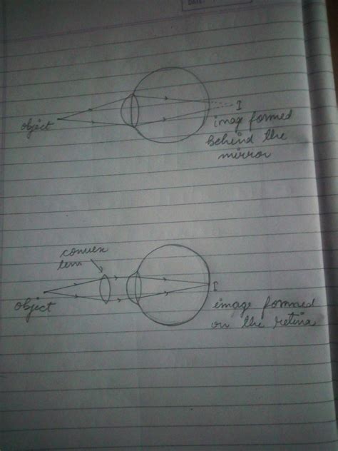 A person using 1.25D lens in his spectacles what kind of defect of ...