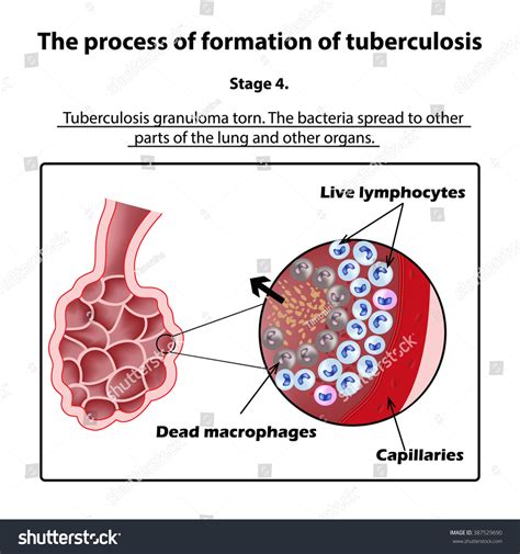 Development Tuberculosis Stage 4 Infographics Illustration: ilustración de stock 387529690
