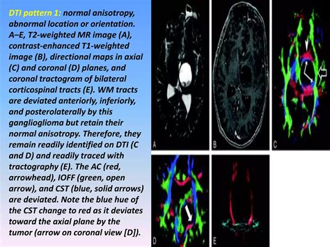 Image result for Diffuse Tensor Imaging