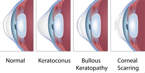 CORNEA ANATOMY & FUNCTIONS