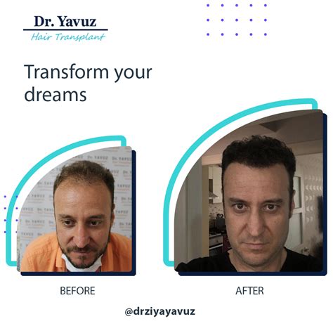 Before After | Dr. Ziya Yavuz