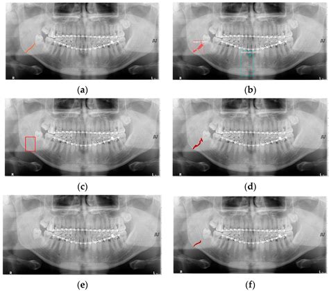 Combined Deep Learning Techniques for Mandibular Fracture Diagnosis ...