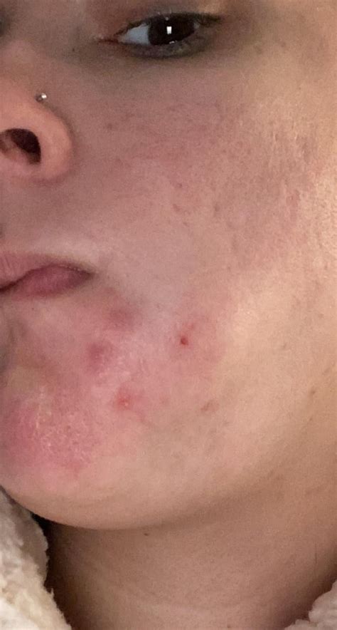 +Massive Exploding Cysts N Boils 的图像结果