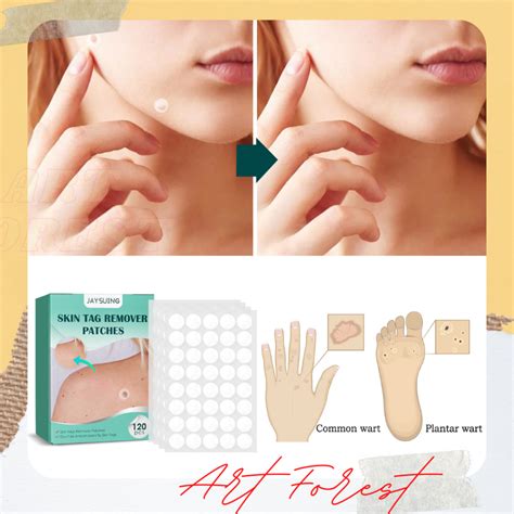 Skin Tag Remover Patch Wart Treatment Stickers Absorb Plaster ...