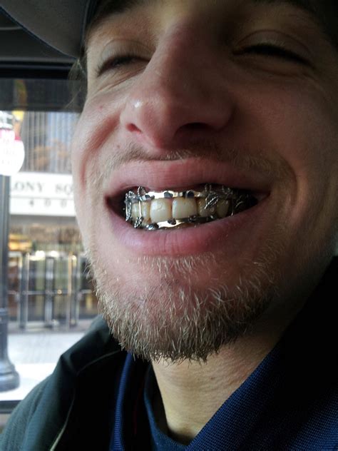 Wiring Jaw Shut Procedure at Declan Odriscoll blog