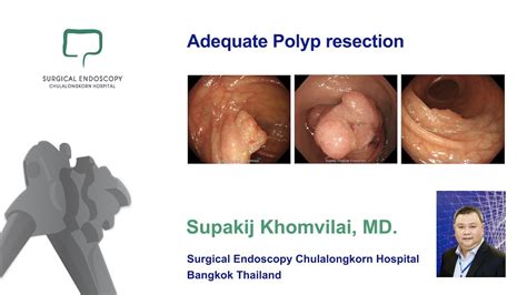 Image result for Post-Polypectomy Care