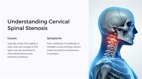 Understanding Disability Ratings For Cervical Spinal Stenosis - Benefits.com - We Make ...