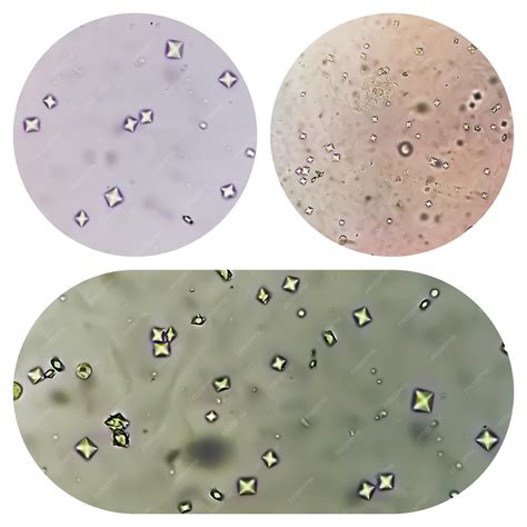 Premium Photo | Three collage of microscopic image showing calcium oxalate crystal from urine ...