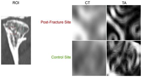 Clinical Evaluation of Magnesium Alloy Osteosynthesis in the Mandibular ...