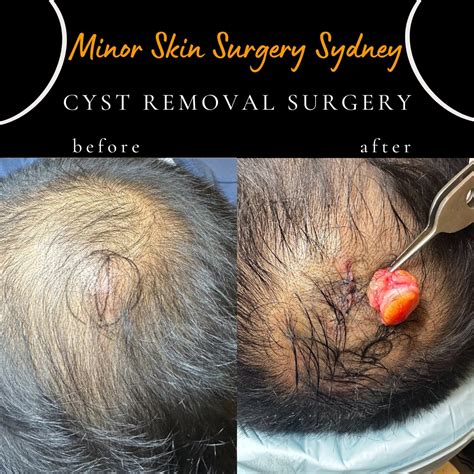 Image result for Cyst Extraction Videos