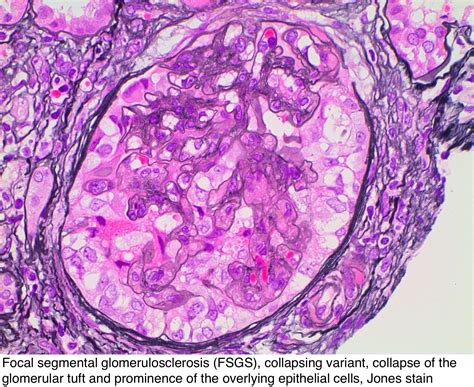 Pathology Outlines - FSGS-collapsing variant