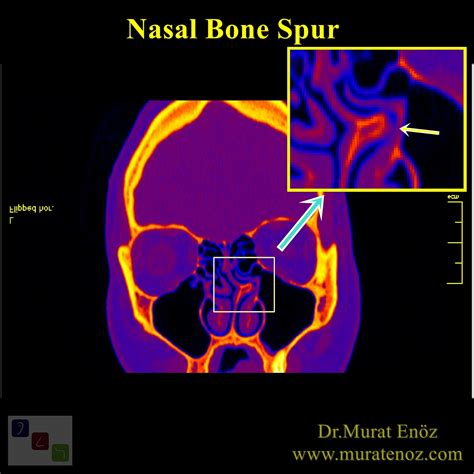 Nasal Bone Spur (Other Reason For Atypical Headache)