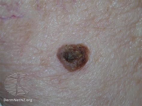 Seborrheic Keratosis: Symptoms, Causes, Diagnosis, and Treatment