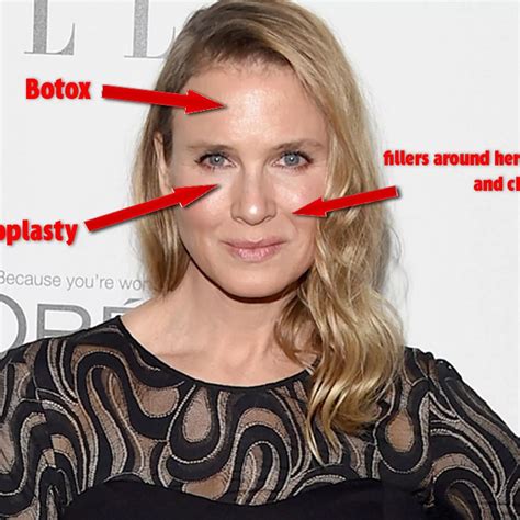 Cosmetic surgery new look renee zellweger now 323998-Renee zellweger cosmetic surgery
