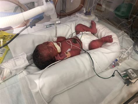 30 Week Pregnancy Delivery