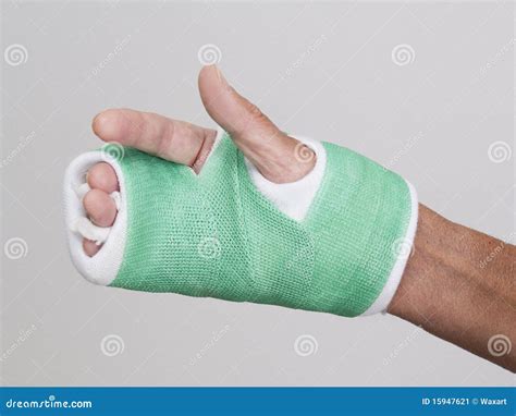 Finger Cast