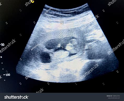 11 Week Ultrasound Pictures Boy