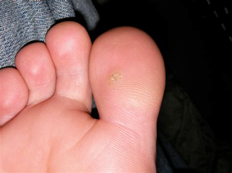 Corns, Calluses & Warts on Feet