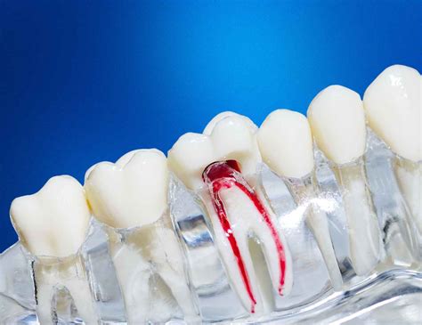 Root Canal Procedure Steps Explained