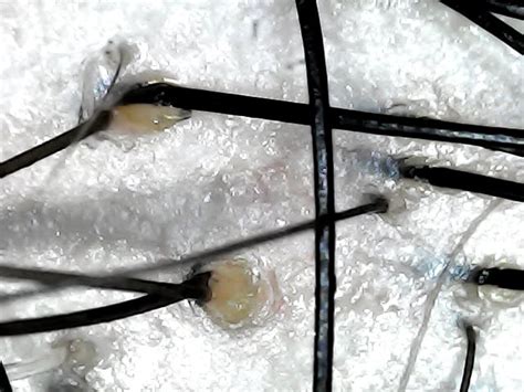 Image result for Sebum Plug Extraction